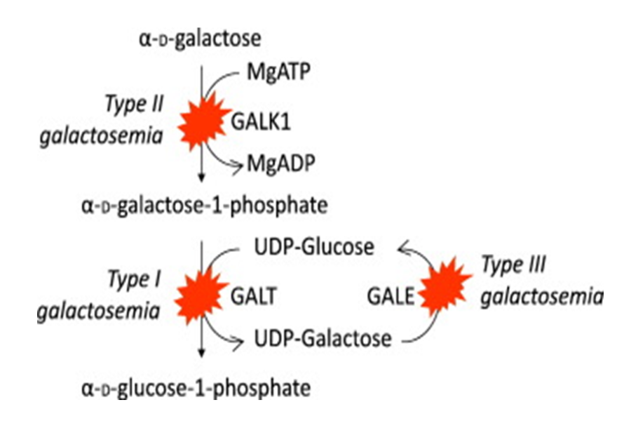 Bệnh galactose máu do đột biến gen gây thiếu hụt enzyme chuyển hoá galactose gây ra