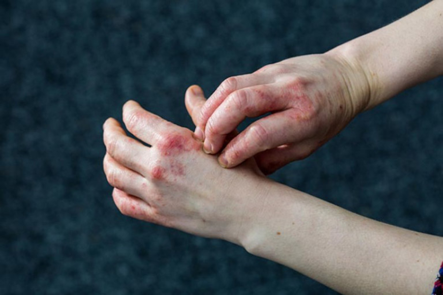 Vảy phấn hồng là một bệnh có biểu hiện dạng phát ban trên da