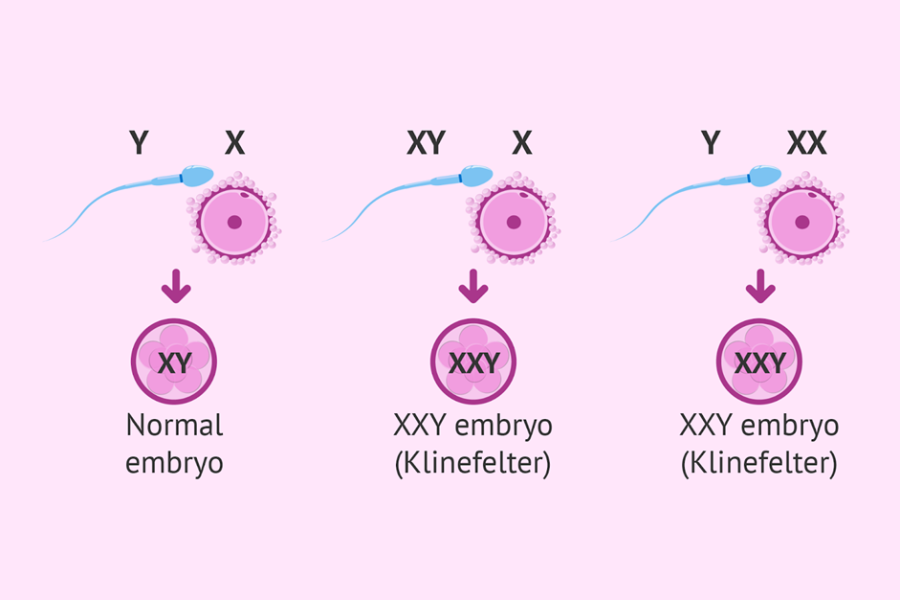 Hội chứng Klinefelter xảy ra khi có thêm một nhiễm sắc thể X trong bộ nhiễm sắc thể.