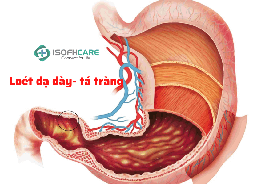 TOP 7+ nguyên nhân gây loét dạ dày tá tràng