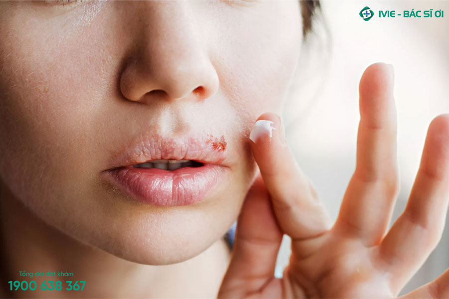 Bệnh herpes cũng có thể là nguyên nhân phổ biến nhất gây ra các mụn nước ở quanh miệng