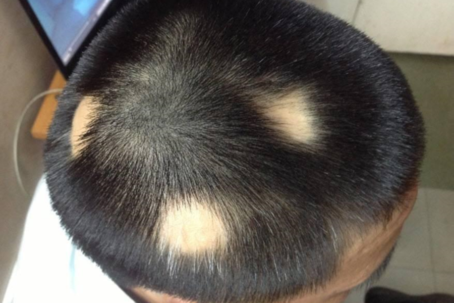 10 địa chỉ khám chữa rụng tóc tốt ở TPHCM và Hà Nội Bạn Nên Biết