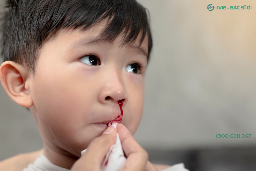 Bố mẹ lau sạch máu ở mũi trẻ để xác định chính xác bên mũi chảy máu