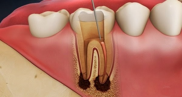 Tất tần tật viêm tủy răng: Nguyên nhân, triệu chứng, điều...