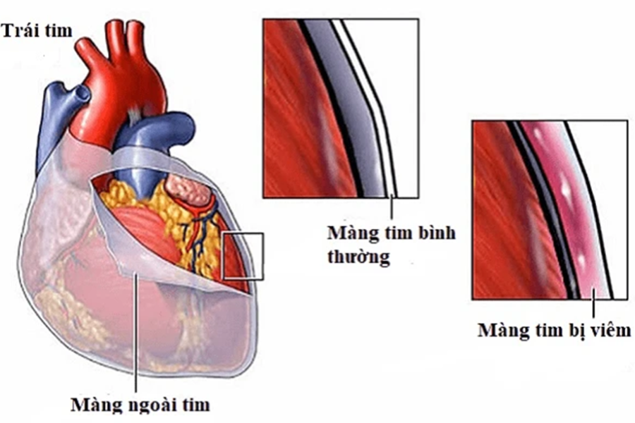Phản ứng viêm theo thời gian làm mất tính đàn hồi và sự co giãn của màng ngoài tim, nguyên nhân gây viêm màng ngoài tim co thắt