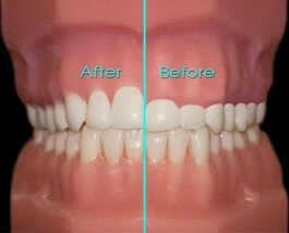Phẫu thuật làm dài thân răng  lâm sàng