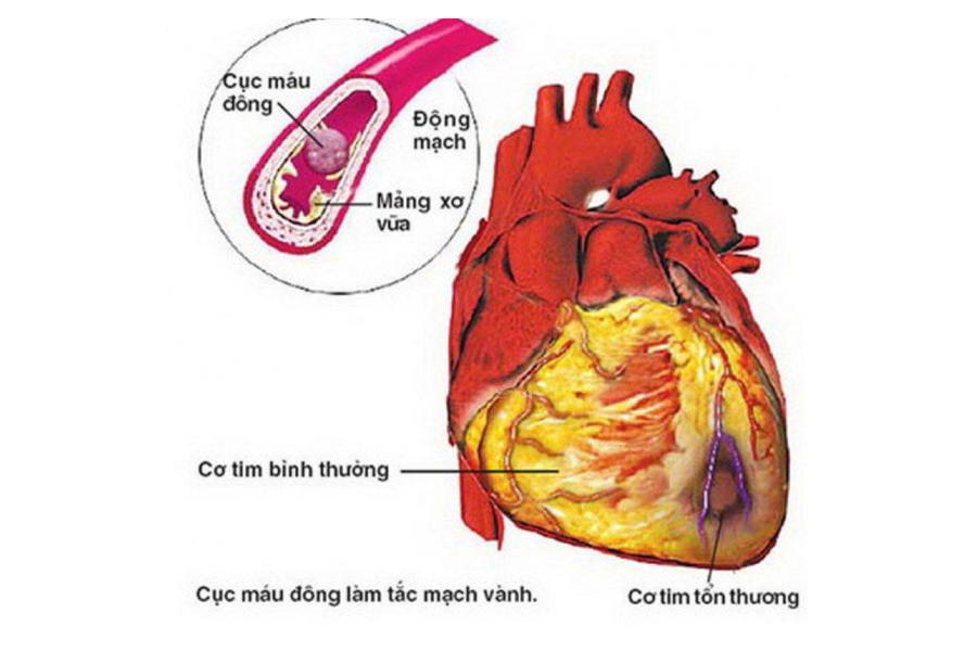 Nhồi máu cơ tim do cục máu đông làm tắc mạch vành gây bệnh tim thiếu máu cục bộ và suy tim, là 2 chỉ định chính của ivabradine trên lâm sàng