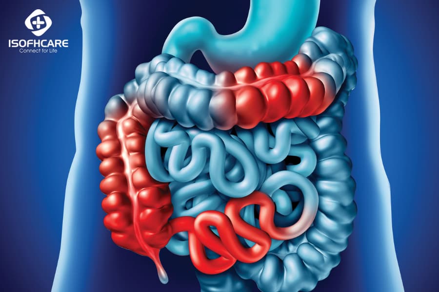 Bệnh Crohn là một trong những bệnh lý đường tiêu hóa nghiêm trọng và cần được chẩn đoán và điều trị đúng cách. Hãy xem hình ảnh để tìm hiểu thêm về những nguyên nhân và cách điều trị bệnh Crohn hiệu quả.