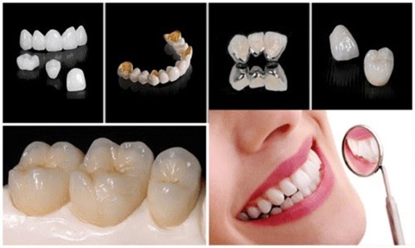 Có những loại răng sứ nào khi lựa chọn trồng răng