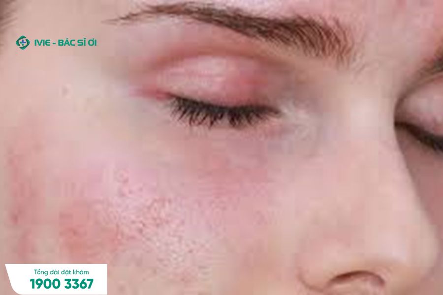 Những mẩn đỏ là một trong những dấu hiệu dị ứng thời tiết da mặt thường gặp