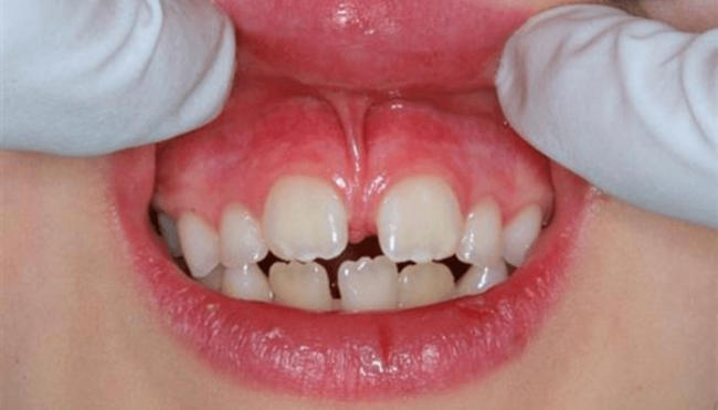 Phẫu thuật phanh môi, lưỡi