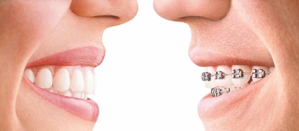 Những nhược điểm của quá trình niềng răng đem lại cho hàm...