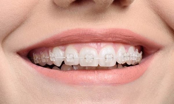 Niềng răng sứ dây trong - giải pháp thẩm mỹ cho hàm răng đẹp