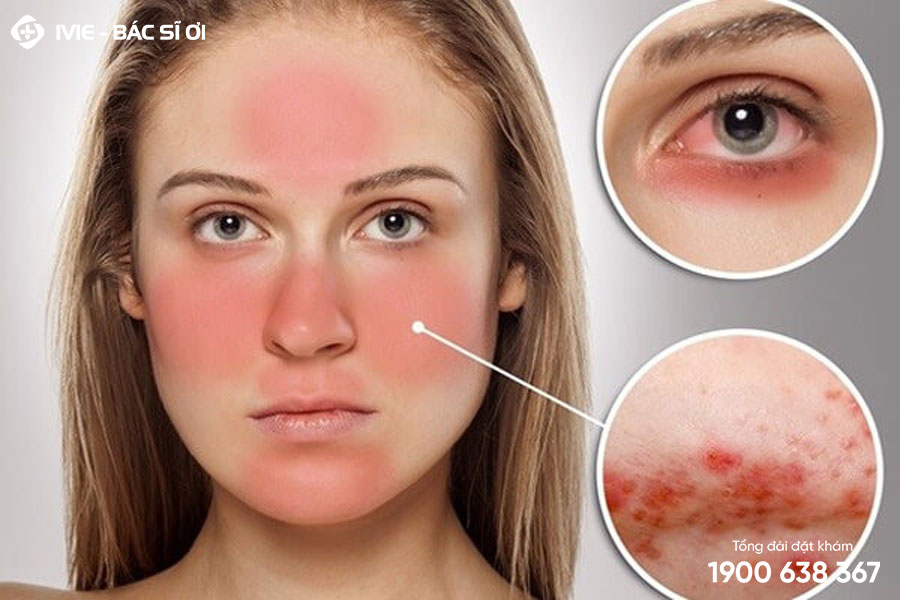 Nổi ban đỏ trên da có thể là dấu hiệu của bệnh Lupus ban đỏ