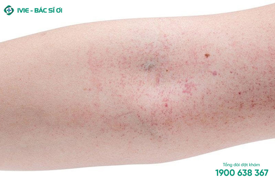Nổi ban đỏ trên da có thể là dấu hiệu của bệnh bảy phấn hồng