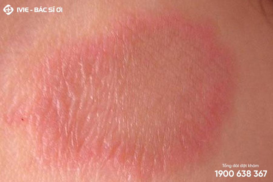Nổi ban đỏ trên da có thể là dấu hiệu của bệnh vảy phấn hồng