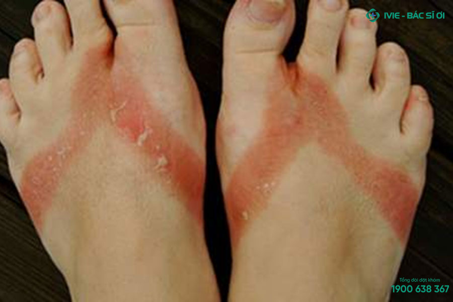 Đeo dép trong thời gian dài gây bệnh viêm da tiếp xúc làm nổi mẩn đỏ ở chân