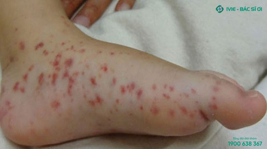 Nổi mẩn đỏ ở chân là tình trạng xảy ra khá phổ biến trên mọi đối tượng