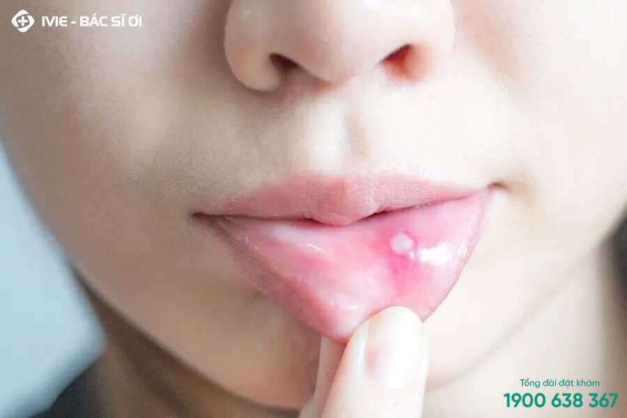 Nổi mụn nước trong miệng có thể gây ra bởi nhiều nguyên nhân
