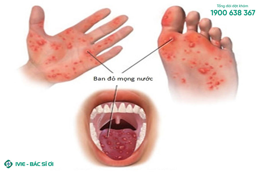 Bệnh tay chân miệng là một căn bệnh truyền nhiễm phổ biến có biểu hiện là các mụn nước ở tay, chân, miệng
