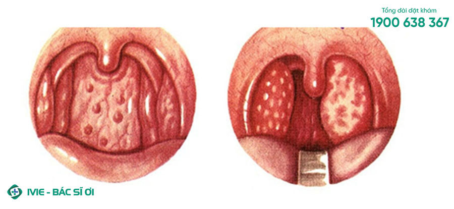 Nổi mụn trắng ở trong miệng có thể là một trong những triệu chứng của bệnh viêm họng hạt
