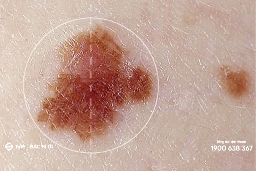Nốt ruồi bị phồng tấy có phải là dấu hiệu của bệnh ung thư da không?