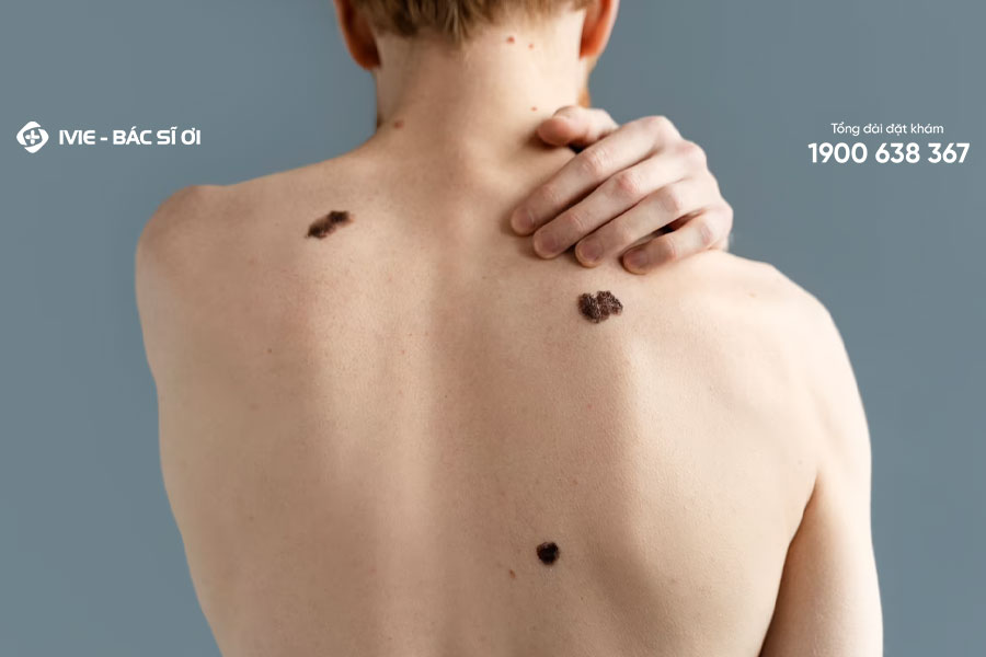 Nốt ruồi có biểu hiện bất thường có thể là dấu hiệu ung thư da
