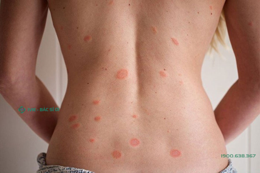 Lupus ban đỏ dạng đĩa khá phổ biến với dấu hiệu da nổi mẩn đỏ thành hình tròn và ngứa