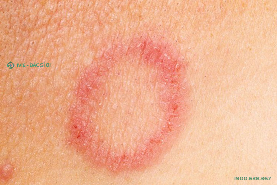 Vết tròn bị nổi đốm đỏ trên da và ngứa là biểu hiện của nhiều bệnh da liễu khác nhau