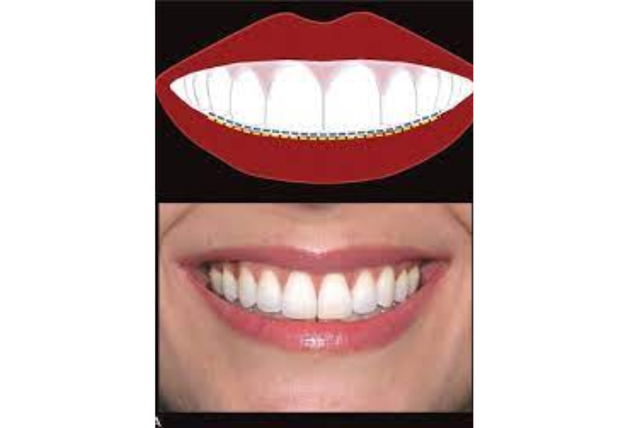 Tương quan về răng trước hàm trên và môi dưới.
