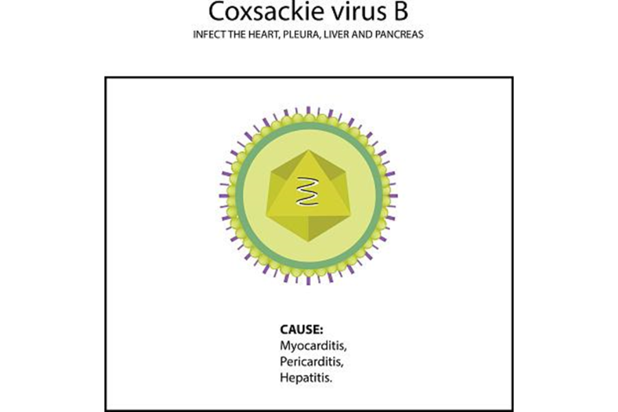 Oxsackie virus B: nguyên nhân thường gặp gây viêm cơ tim ở các nước phương Tây