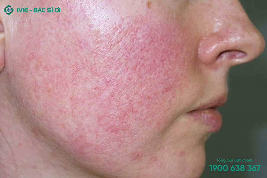 Peel da có thể gây ra các biến chứng không mong muốn như bỏng da