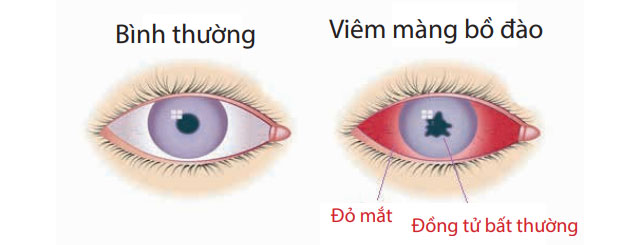 Phân biệt các loại viêm màng bồ đào mắt