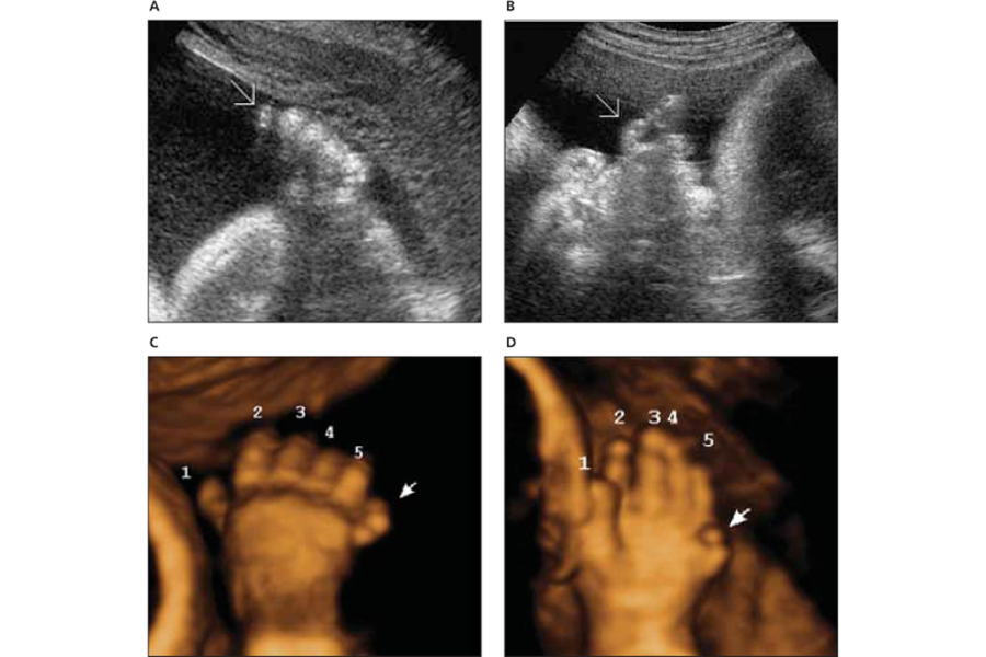 Dị tật thừa ngón cái có thể được phát hiện thông qua phương pháp siêu âm cho thai phụ