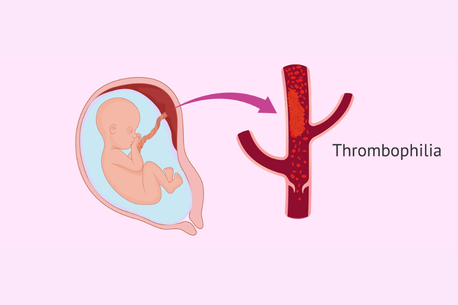 Thrombophilia với phụ nữ mang thai