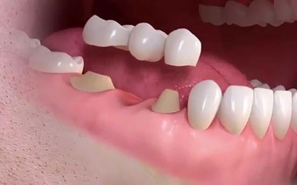 Phương pháp bắc cầu răng