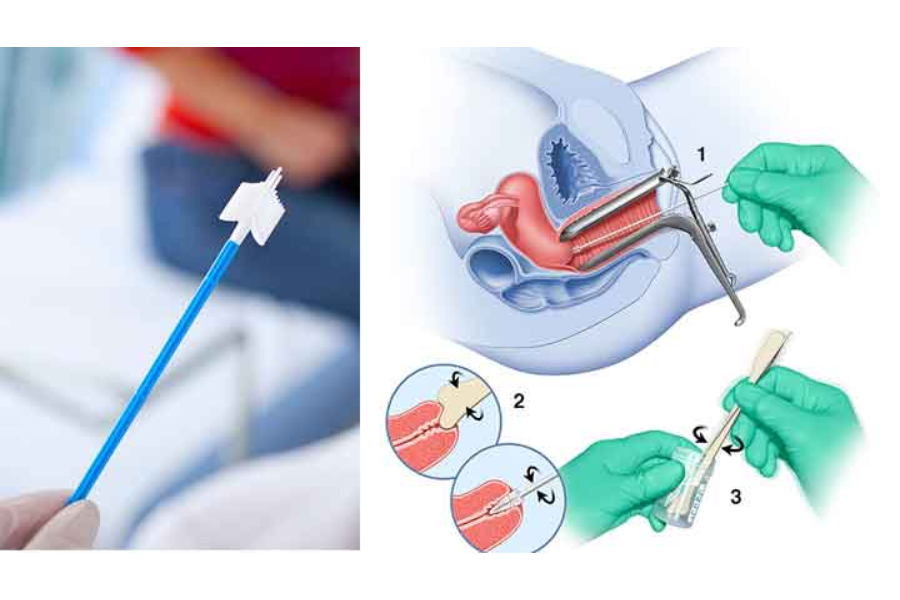 Phương pháp Pap smear - phết tế bào