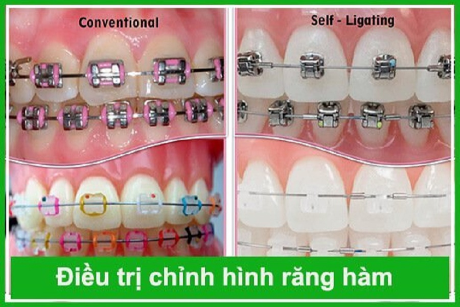 Các phương pháp điều trị chỉnh hình hàm răng