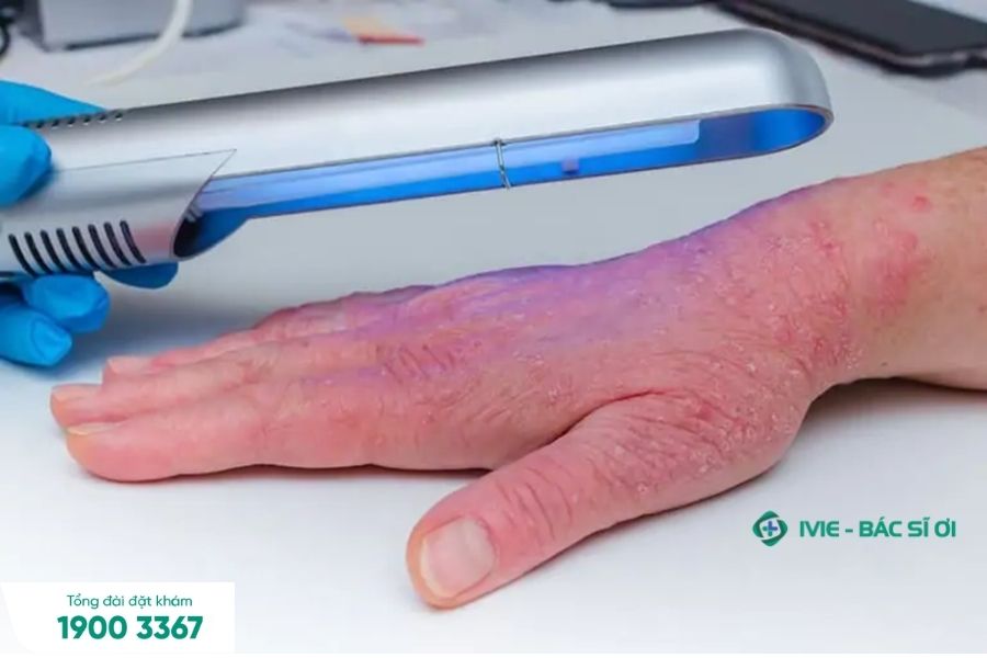 Phương pháp quang trị liệu giúp hỗ trợ điều trị chàm da tay hiệu quả