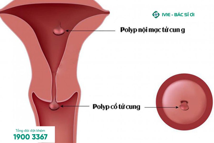Polyp cổ tử cung là nguyên nhân thường gặp gây chảy máu sau giao hợp