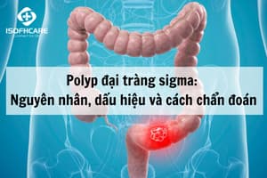 Polyp đại tràng sigma: Nguyên nhân, dấu hiệu và cách chẩn...