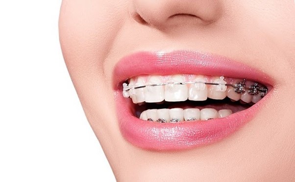 Quá trình niềng răng tại Nha khoa diễn ra như thế nào?