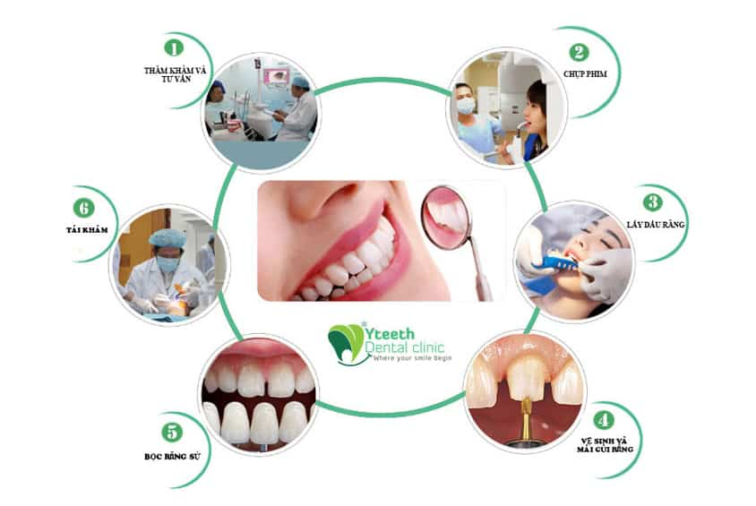 Quy trình bọc răng sức an toàn - khép kín tại Nha khoa Yteeth