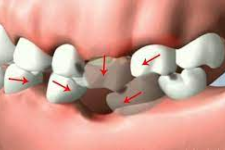 Sau khi cố gắng một thời gian dài để có hàm răng đều, đẹp, nhưng lại không duy trì sau chỉnh nha.