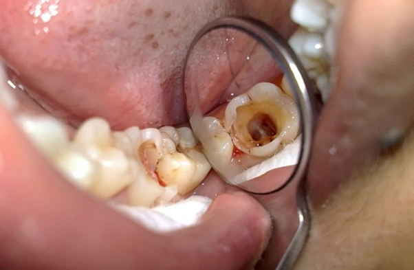 Răng sâu có nên trồng răng