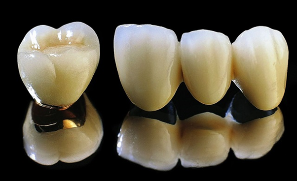 Răng sứ titan có tốt không? Tất tần tật về loại răng sứ...
