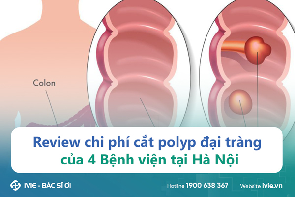 Review chi phí cắt polyp đại tràng của 4 Bệnh viện tại Hà...