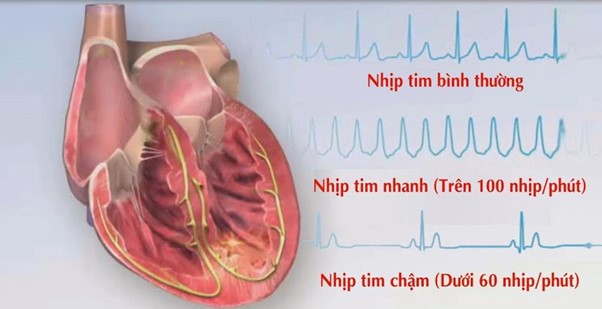 Tìm hiểu về rối loạn nhịp tim – Một trong những biểu hiện...