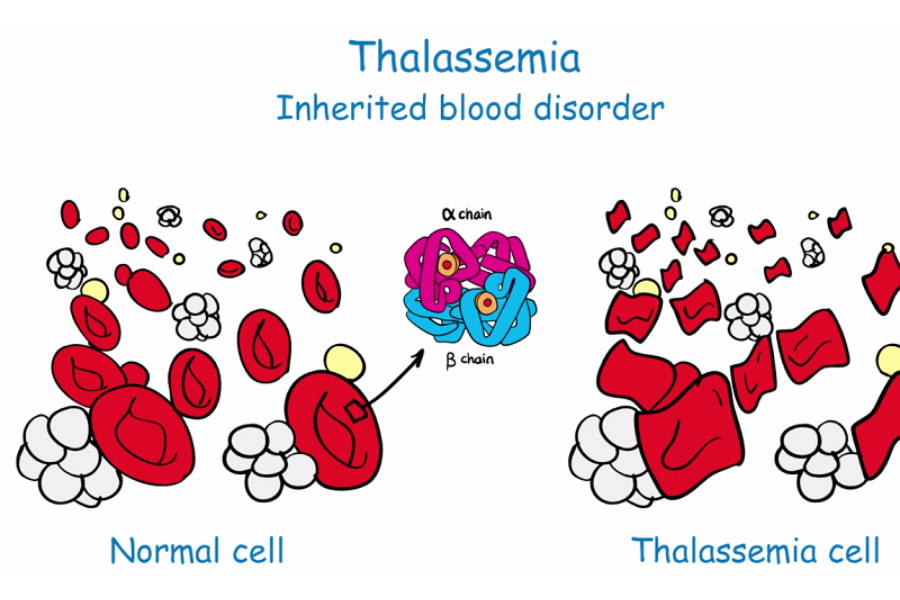 Thalassemia là một rối loạn máu di truyền
