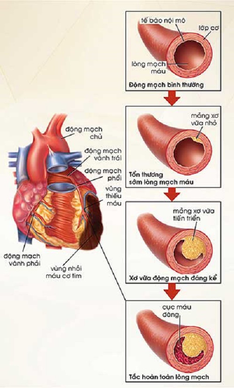 Rối loạn mỡ máu và mối liên quan với bệnh tim mạch